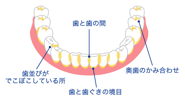 歯石